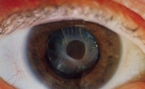 eye 500