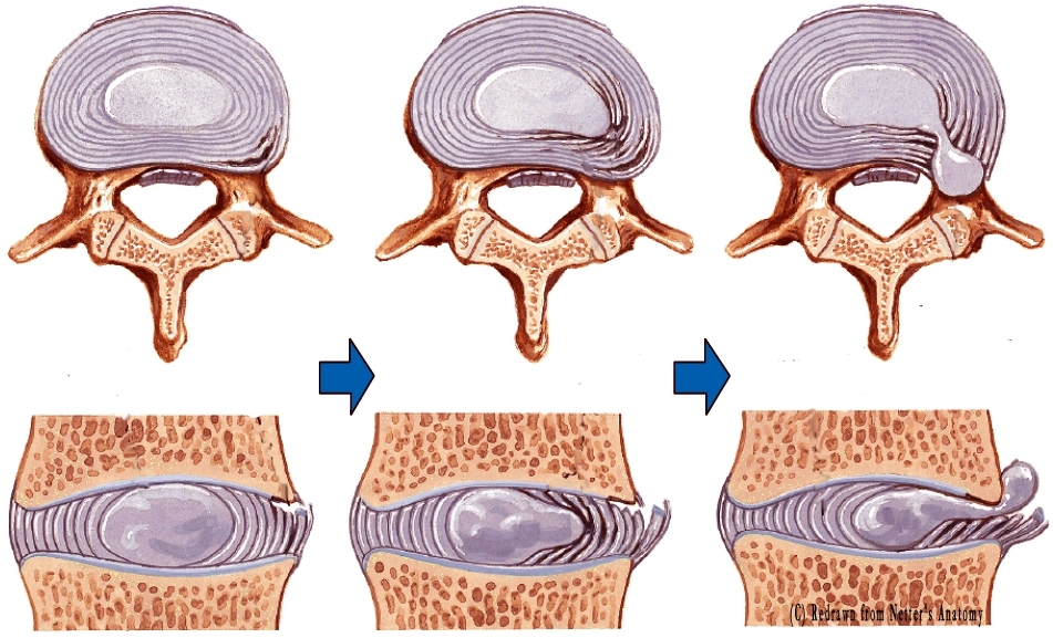hernia-01